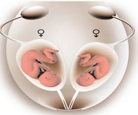 女子双子宫怀龙凤胎，一边各住一个，这是一种什么现象？